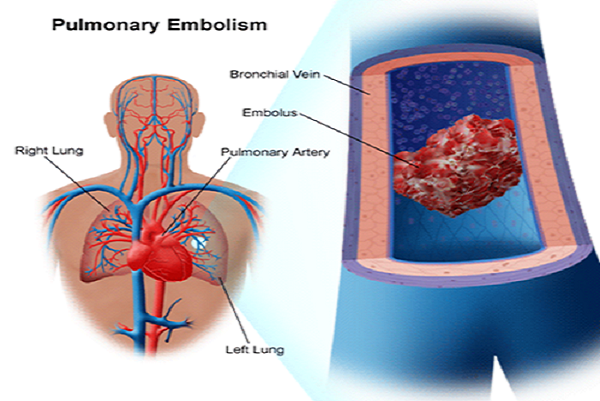 10 Signs Of Blood Clot In Lung Thrombocytes