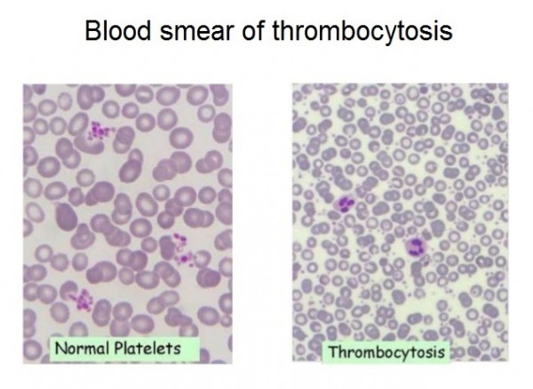 10-causes-of-high-platelet-count