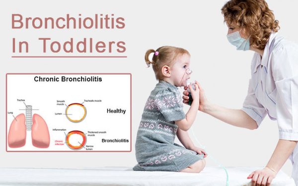 10 Best Food & Diet (Meal Plan) for Bronchiolitis